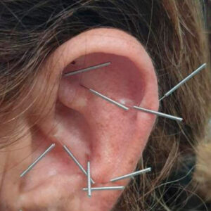 Curso de Auriculoterapia