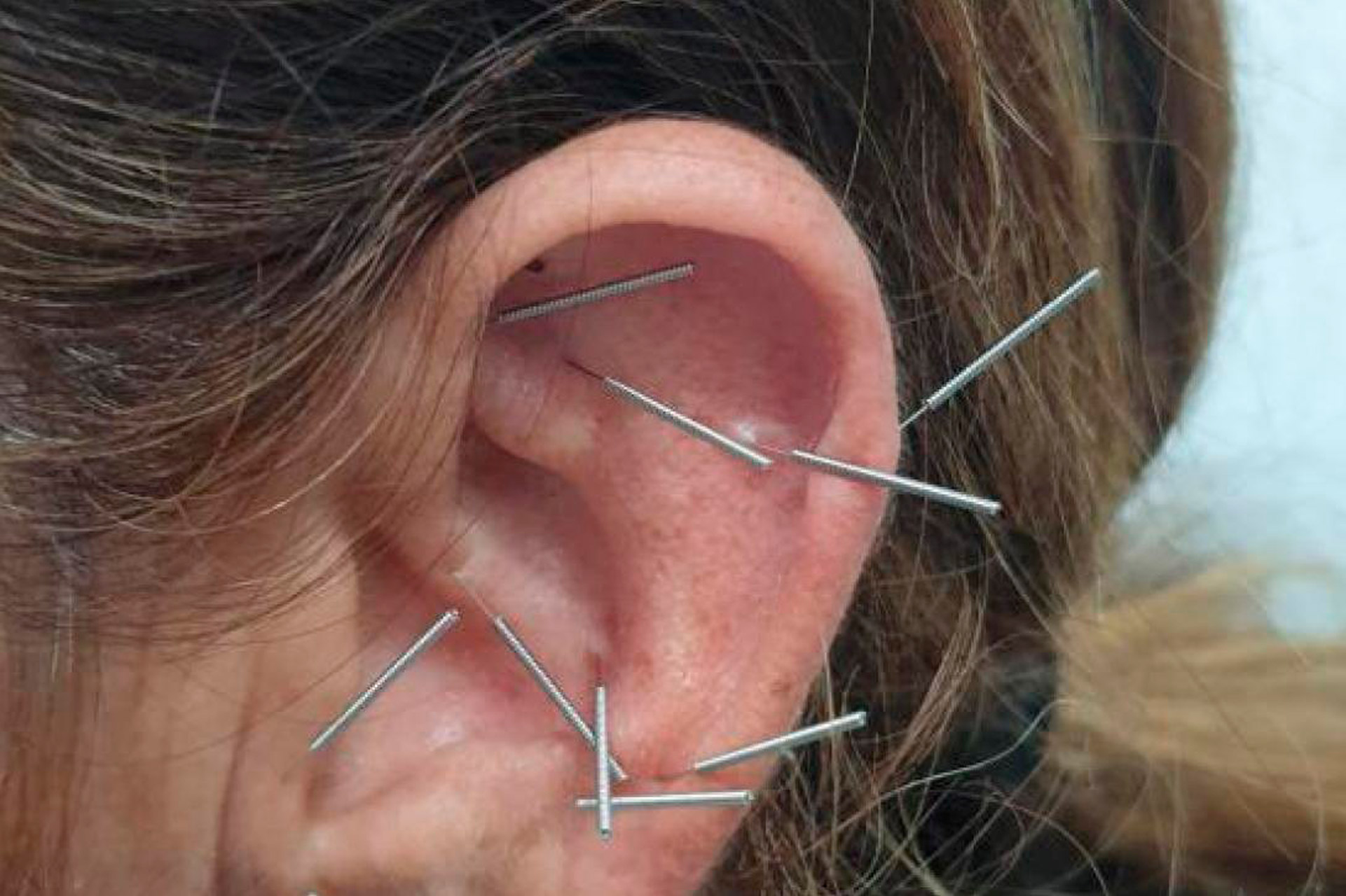 Curso de Auriculoterapia