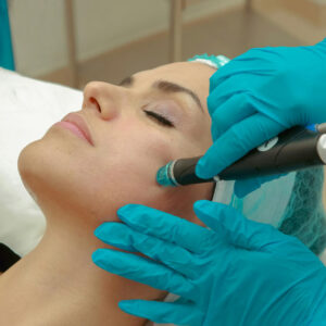Diamond Peel (Punta de diamante)